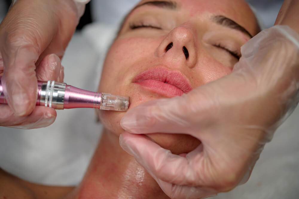 woman getting microneedling