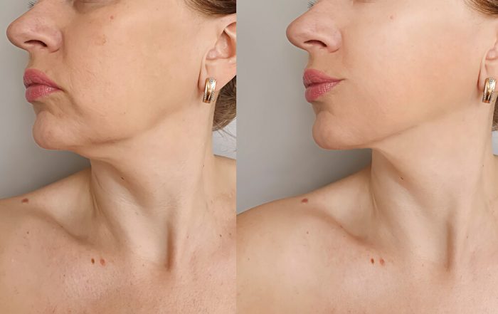 jaw and chin filler