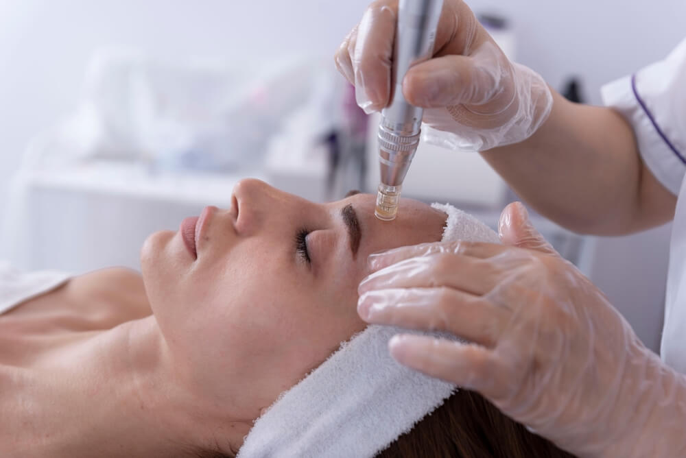 microneedling treatment