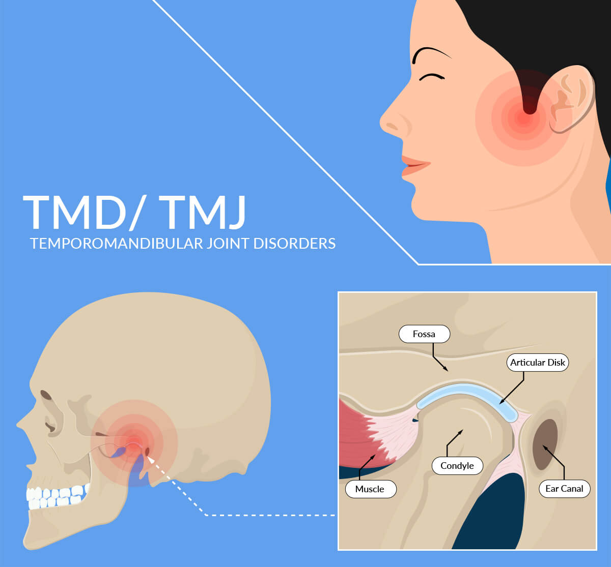 Botox For Tmj Relief Blog Beauty Tips Introlift Medical Spa