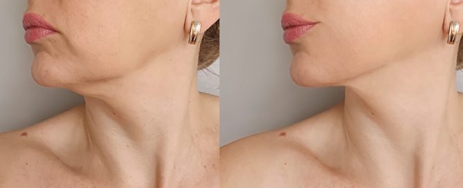 jaw and chin filler