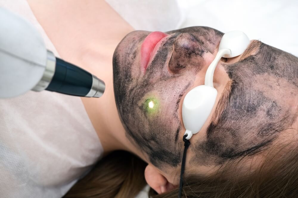 carbon laser peel