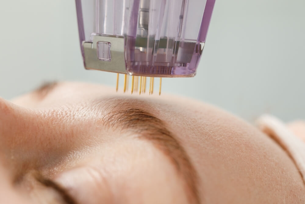 microneedling treatment